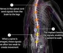 चीन में एक पैरालाइज्ड व्यक्ति ने AI और ब्रेन-स्पाइन इंप्लांट की मदद से दोबारा चलना शुरू किया है। जानिए इस चमत्कारिक तकनीक के बारे में, जो मेडिकल साइंस में क्रांति ला सकती है।
